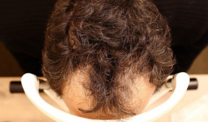 Tratamiento de la alopecia con Finasteride